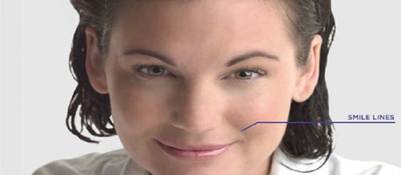 Facial Lines