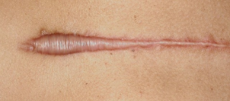 Chicken Pox Scars