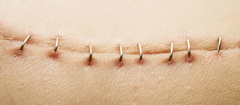 Thick Scars