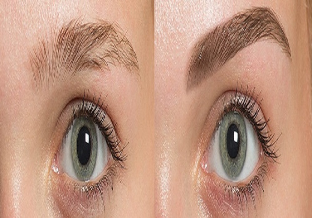 Hair Transplant
