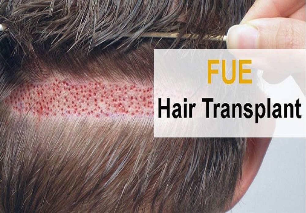 Dandruff Treatment