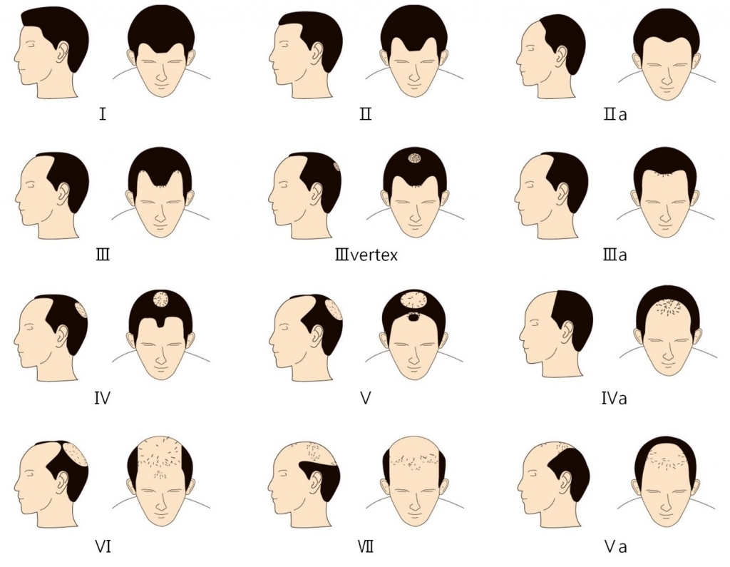 Hair Loss Stages